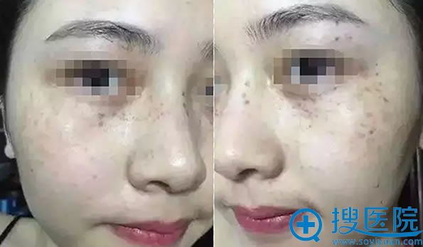 皮秒祛斑术后第2天照片