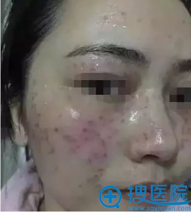 在蚌埠美莱整形医院祛斑术前照