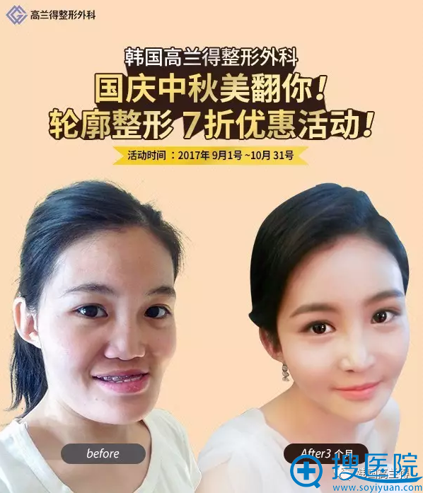 韩国高兰得整形外科医院国庆节轮廓手术7折优惠还有案例图哦 整形美容行业新闻资讯 搜医院 韩国高兰得整形外科医院国庆节轮廓手术7折优惠还有案例图哦 整形美容行业新闻资讯 搜医院