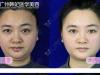 在广州韩妃医学美容医院体验面部线雕提升手术全部过程