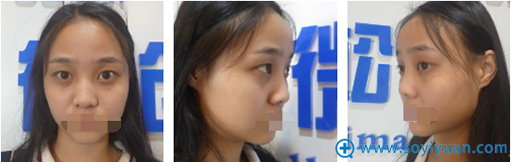 崔向葵切开双眼皮术前照片
