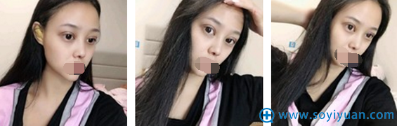 崔向葵切开双眼皮术后当天效果