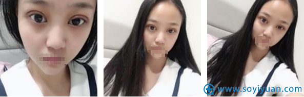 合肥崔劲松医疗美容诊所切开双眼皮术后3天