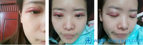 武汉洪山爱美汇瞿敏双眼皮术后1天效果