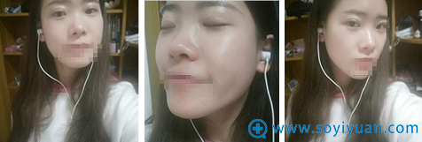 武汉爱美汇瞿敏切开双眼皮术后3个月恢复照片