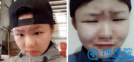 常州施尔美整形美容医院双眼皮术前照片