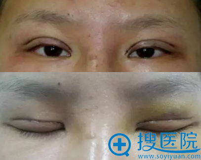 常州施尔美整形双眼皮术后1天睁眼闭眼效果