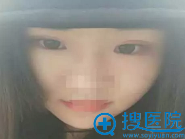 常州施尔美整形美容医院双眼皮2个月恢复情况