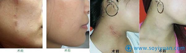 韩国主恩外科医院去疤痕案例图片