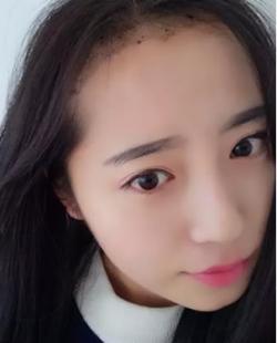 20岁美女在吴氏嘉美门诊部种植发际线前后对比照片