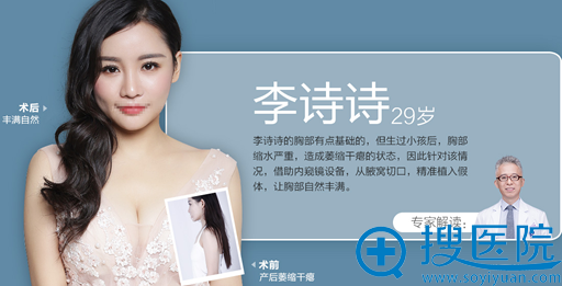 长沙美莱<!--<i data=20240710 data-id=16314></i>-->假体丰胸案例
