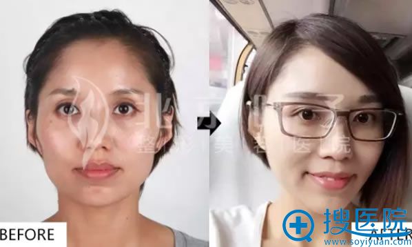 北京叶子整形医院自体脂肪填充全脸前后对比图