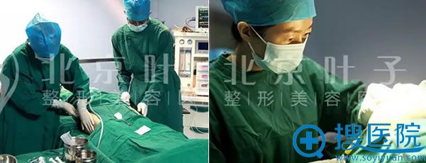 抽取大腿脂肪和填充手术过程