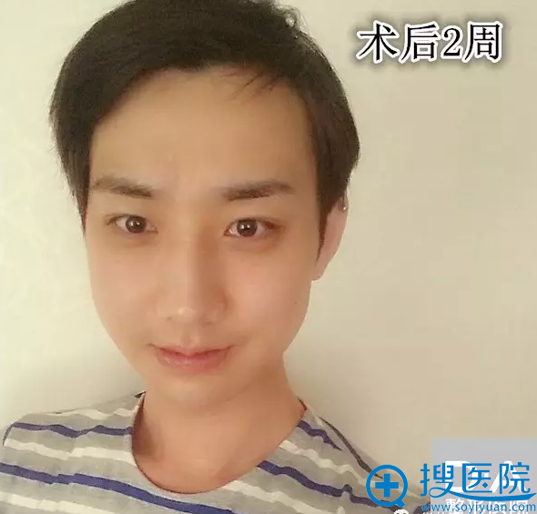 地包天改善术后两周效果