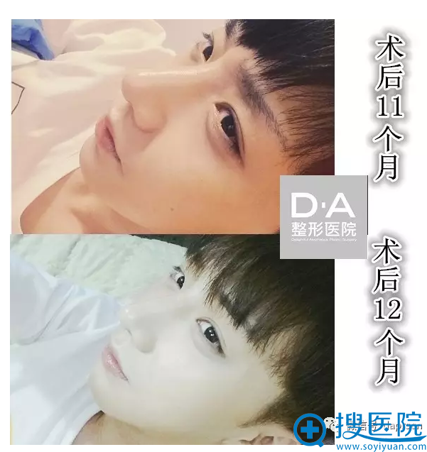 韩国DA整形医院两颚+隆鼻术后1年生活照