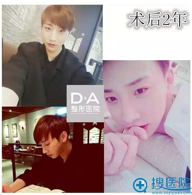 韩国DA整形医院两颚+隆鼻术后2年自拍