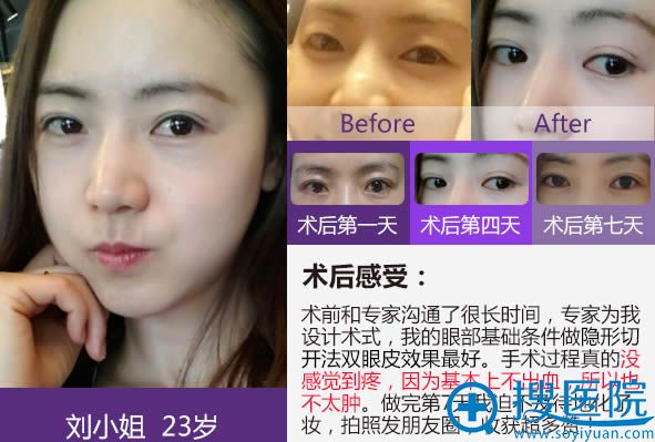 杨荣华切开双眼皮前后对比案例