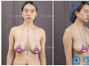 乳房下垂怎么办？上海华美李健乳房悬吊提升术后恢复图片分享