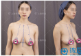 乳房下垂怎么办？上海华美李健乳房悬吊提升术后恢复图片分享