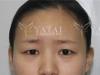 26岁小鸢公开在宜昌亚太整形做双眼皮10天后的照片
