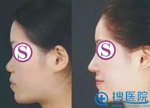 维多利亚注射隆鼻和下巴案例
