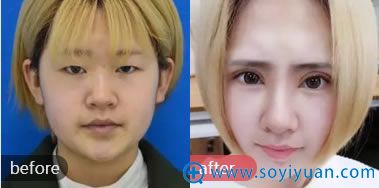 星艺整形双眼皮手术案例