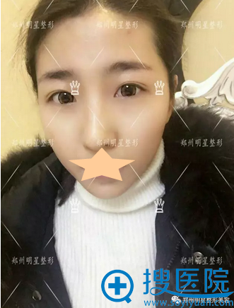 郑州<!--<i data=20240710 data-id=16639></i>-->双眼皮修复术前照片