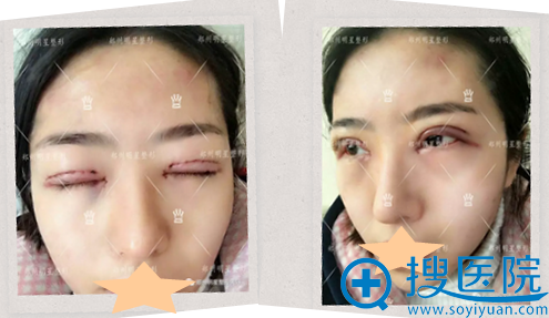 <!--<i data=20240710 data-id=9128></i>-->整形医院双眼皮修复术后睁眼闭眼效果