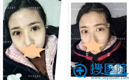 郑州<!--<i data=20240710 data-id=16639></i>-->双眼皮修复手术拆线效果
