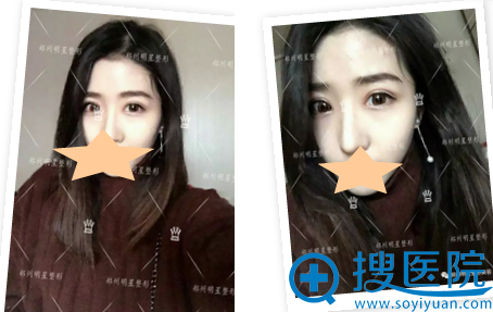 <!--<i data=20240710 data-id=9128></i>-->整形医院双眼皮术后1个月