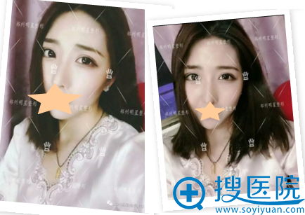 双眼皮修复术后3个月效果