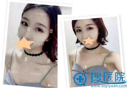 郑州<!--<i data=20240710 data-id=16639></i>-->双眼皮修复术后4个月照片