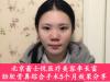 北京蕾士悦医疗美容李长富肋软骨鼻综合手术5个月效果分享