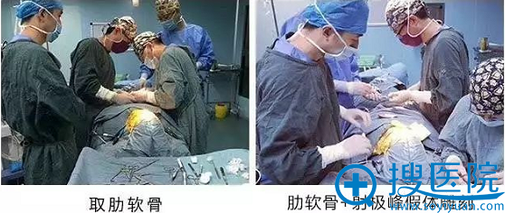 肋软骨+射极峰假体雕刻过程