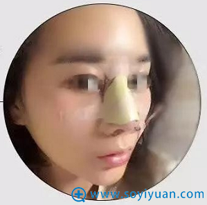 <!--<i data=20240710 data-id=12143></i>-->肋软骨隆鼻术后1天效果