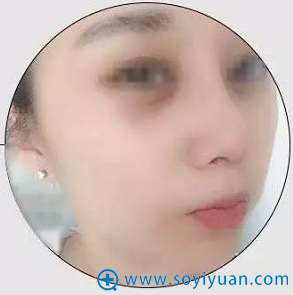 <!--<i data=20240710 data-id=12143></i>-->假体隆鼻拆线效果展示