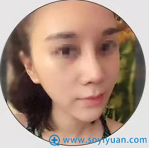肋软骨+射极峰假体隆鼻术后15天效果