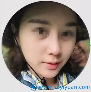 <!--<i data=20240710 data-id=12143></i>-->肋软骨隆鼻术后1个月恢复效果