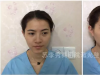 我的全脸玻尿酸填充亲身经历告诉你佛山苏李秀英整形医院怎么样