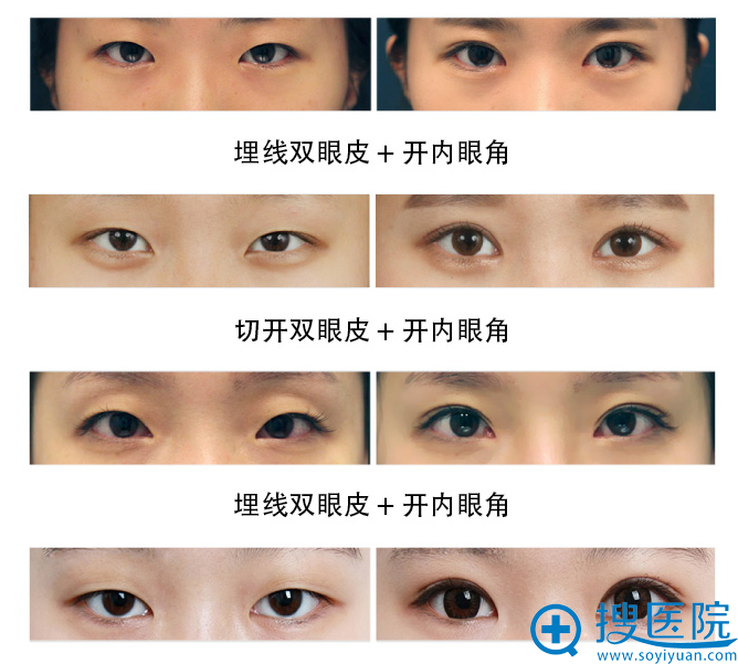 上海铂曼医疗美容医院双眼皮案例