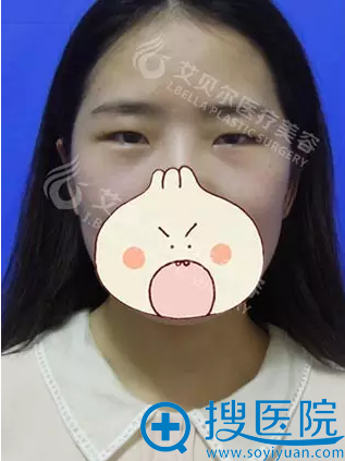 <!--<i data=20240710 data-id=8113></i>-->石东文双眼皮+开眼角术前照
