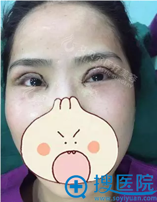 石东文切开双眼皮+开内眼角术后即刻