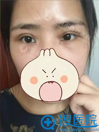 <!--<i data=20240710 data-id=8113></i>-->切开双眼皮拆线后效果