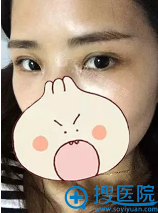 <!--<i data=20240710 data-id=8113></i>-->双眼皮+开眼角术后30天效果