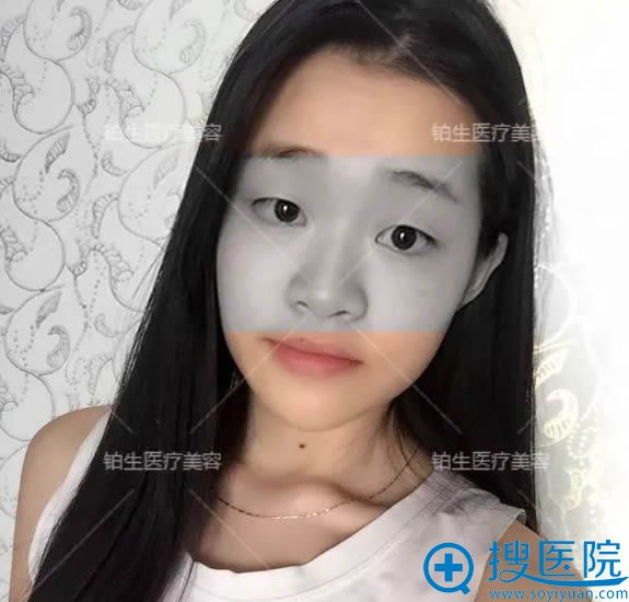 在<!--<i data=20240710 data-id=12390></i>-->医院做眼鼻整形前的样子 在<!--<i data=20240710 data-id=12390></i>-->医院做眼鼻整形前的样子