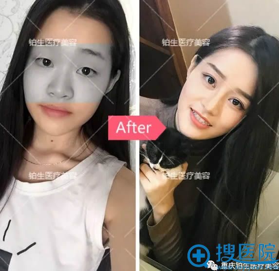 <!--<i data=20240710 data-id=12390></i>-->方得海眼鼻整形前后对比图 <!--<i data=20240710 data-id=12390></i>-->方得海眼鼻整形前后对比图