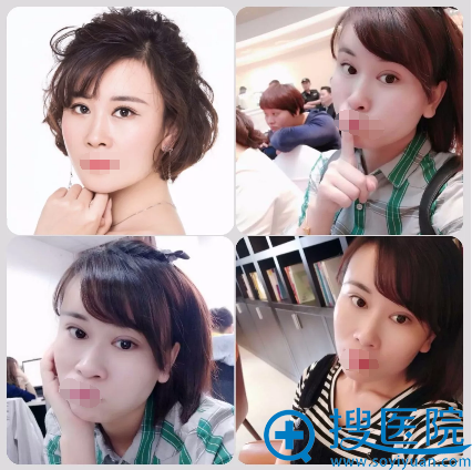 眼综合+自体脂肪填充+手术一个月恢复照片
