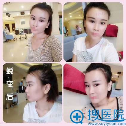 <!--<i data=20240710 data-id=12037></i>-->眼综合+自体脂肪填充半个月恢复效果
