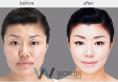 韩国做面部轮廓比较好的医院是原辰整形外科吗？
