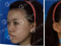 福州台江整形医院虞守辉玻尿酸填充全脸术前术后对比照片分享